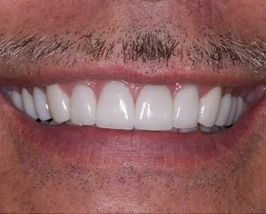 After: an even, bright row of porcelain veneers.