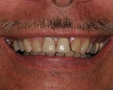 Before: worn, discolored and uneven upper front teeth.