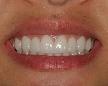 After: the gaps closed with porcelain veneers.