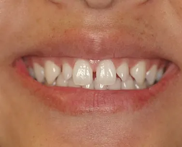 Before: narrow front teeth with gaps between them.