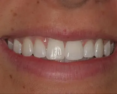 After: the same teeth straightened into an even arch.