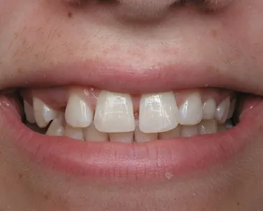 Before: crowded, overlapping front teeth.