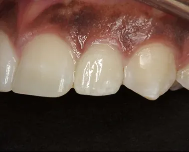 After: the gap filled by an implant crown matched to its neighbors.