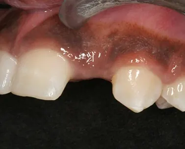 Before: a gap where an upper front tooth is missing.