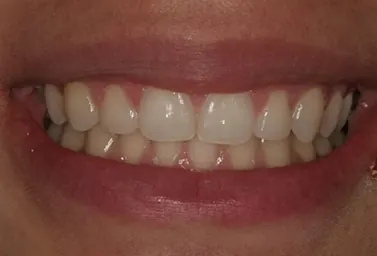 A patient's smile after orthodontic treatment at the practice.